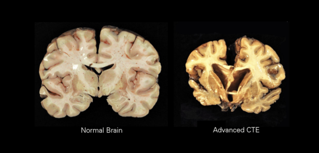 Image of two brain sections, the one of the left shows a normal brain and the one on the right shows a brain with CTE